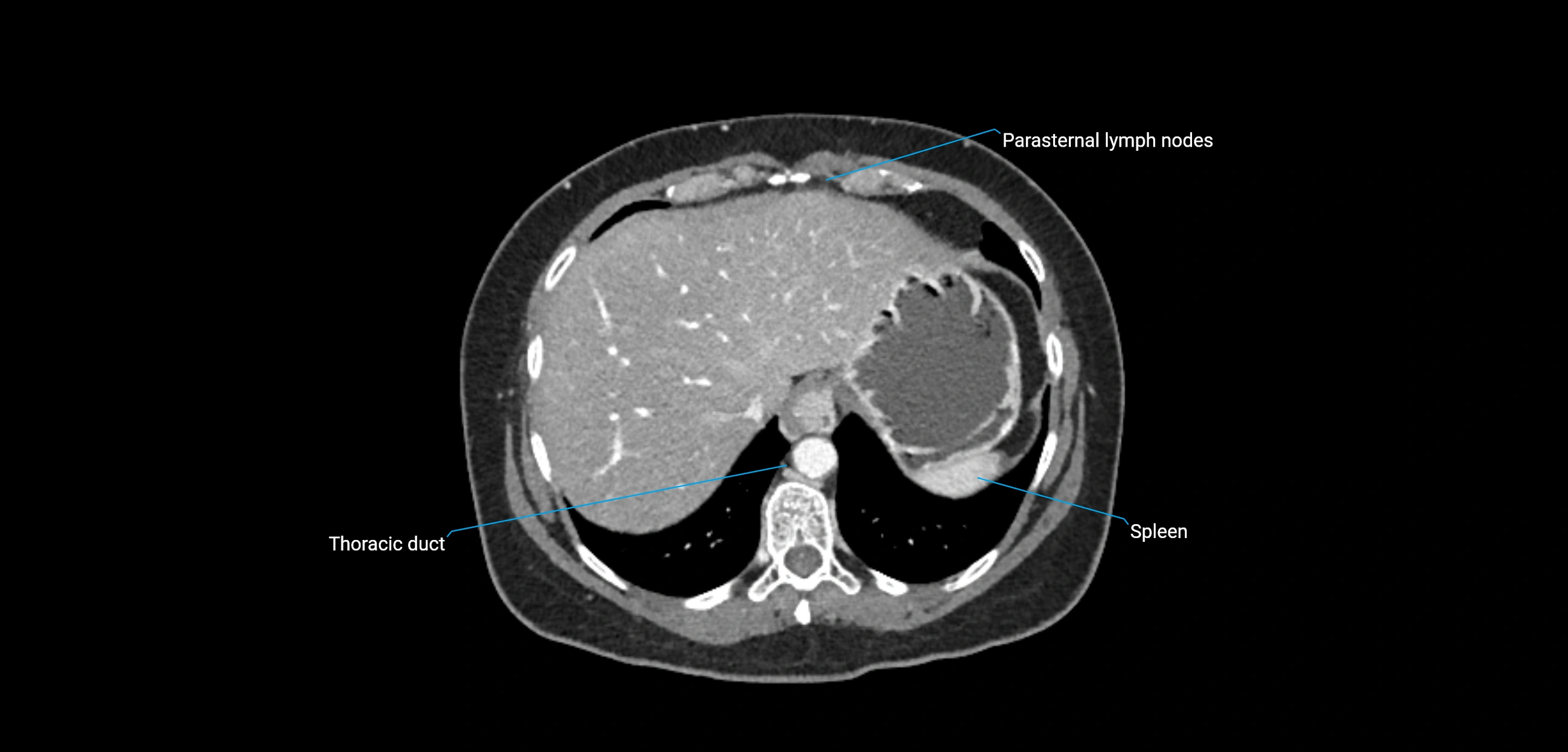 CT ct abdominal lymph nodes  axial cross sectional anatomy  enchanced radiology image -img-00002-00084.webp